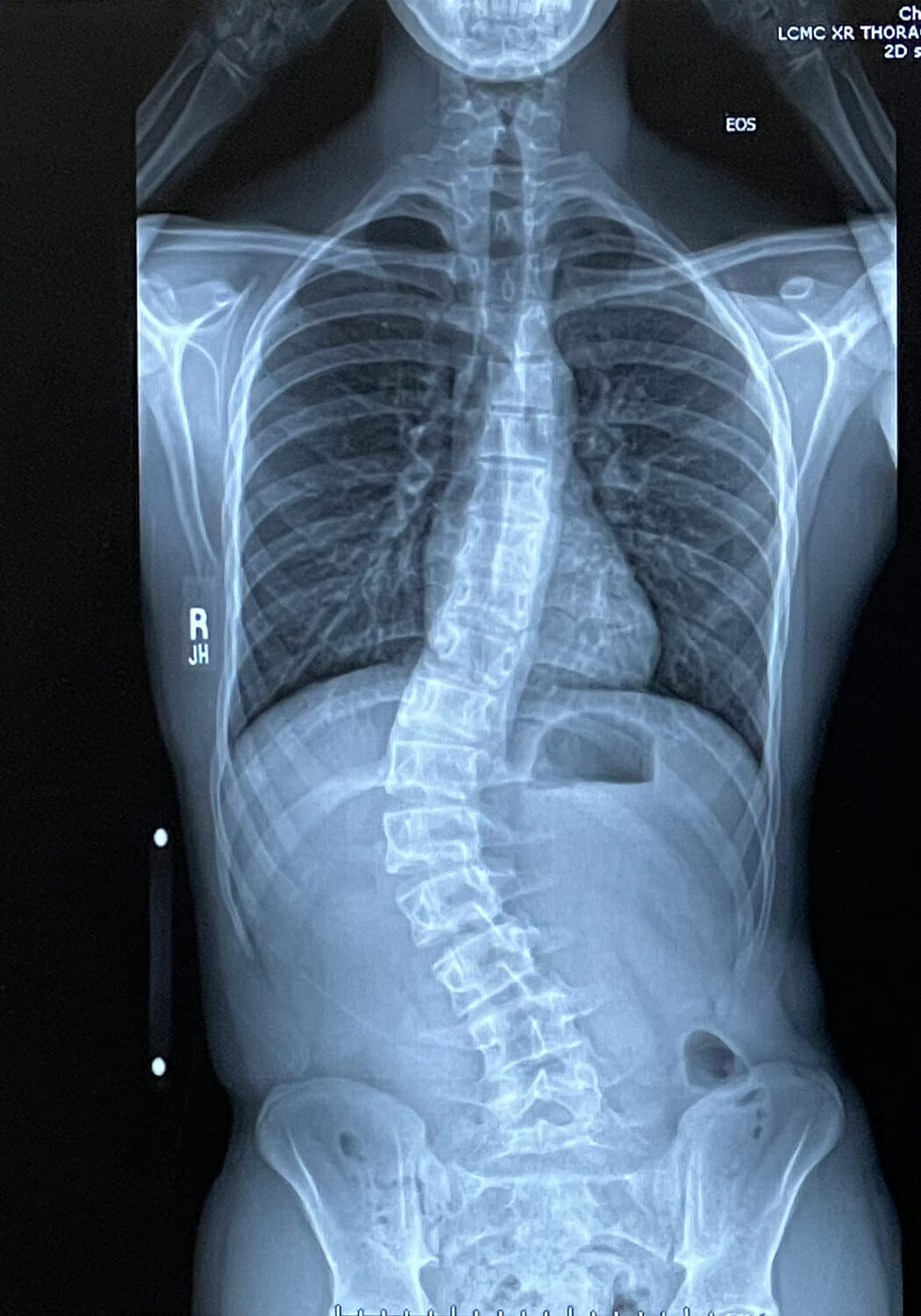 teen male scoliosis 