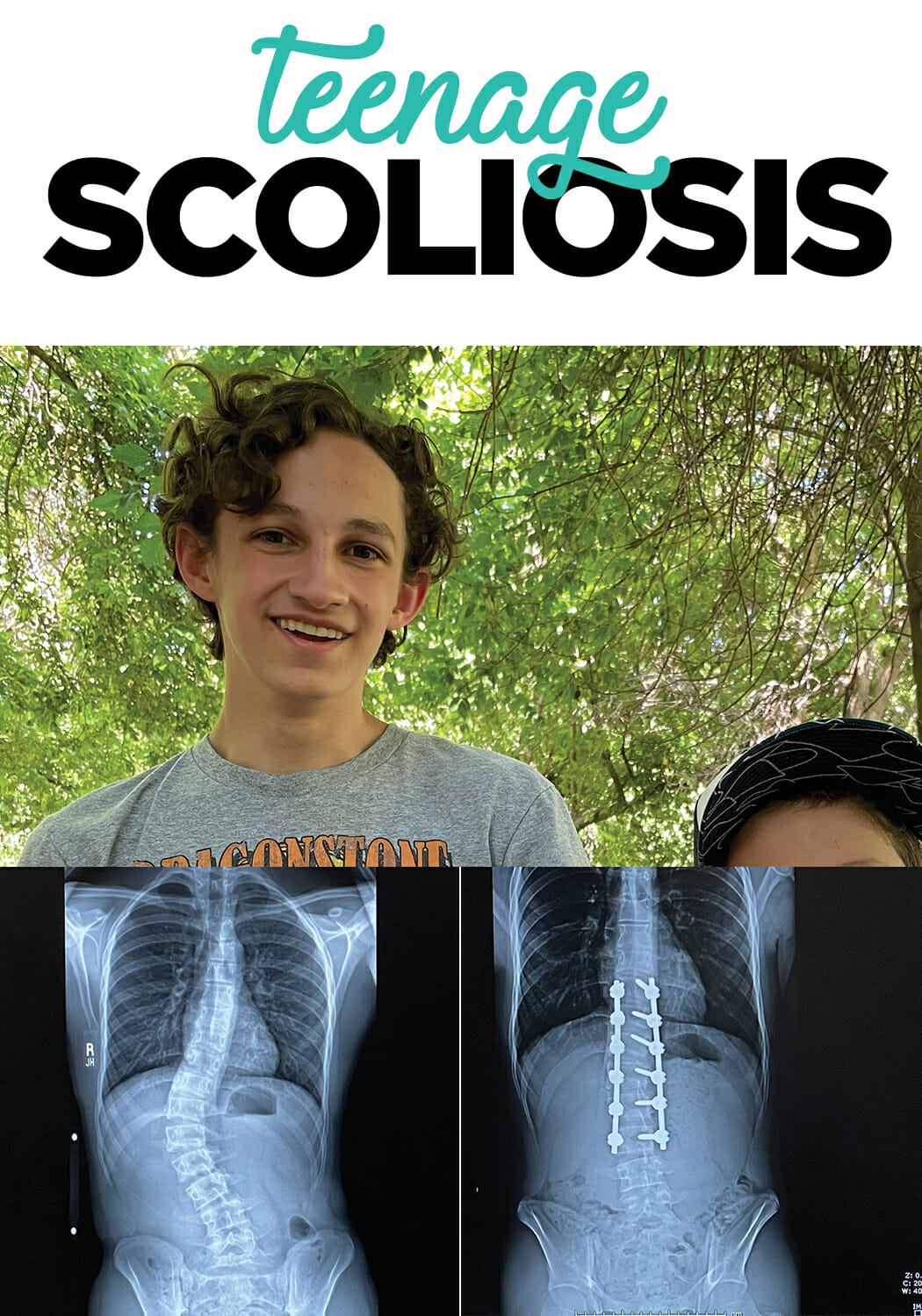 picture of teen boy and before and after x-rays of scoliosis